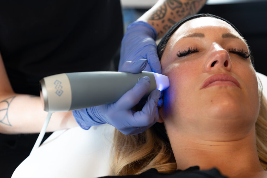 A patient receives Microneedling in Lakewood, CO