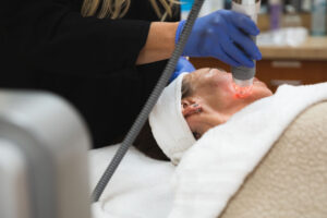 A woman receives RF Microneedling in Centennial, CO