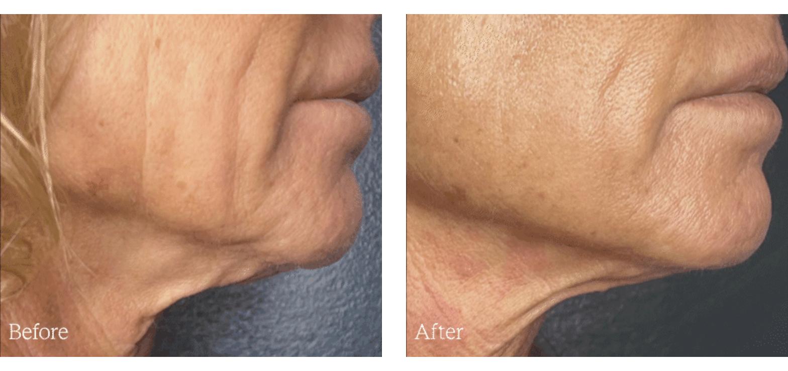 Density before and after, jawline and neck
